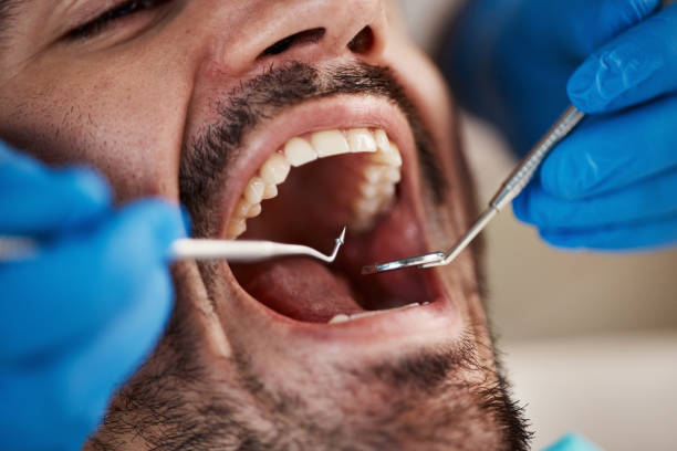 Best Chipped Tooth Repair Near Me  in Sturgis, MI